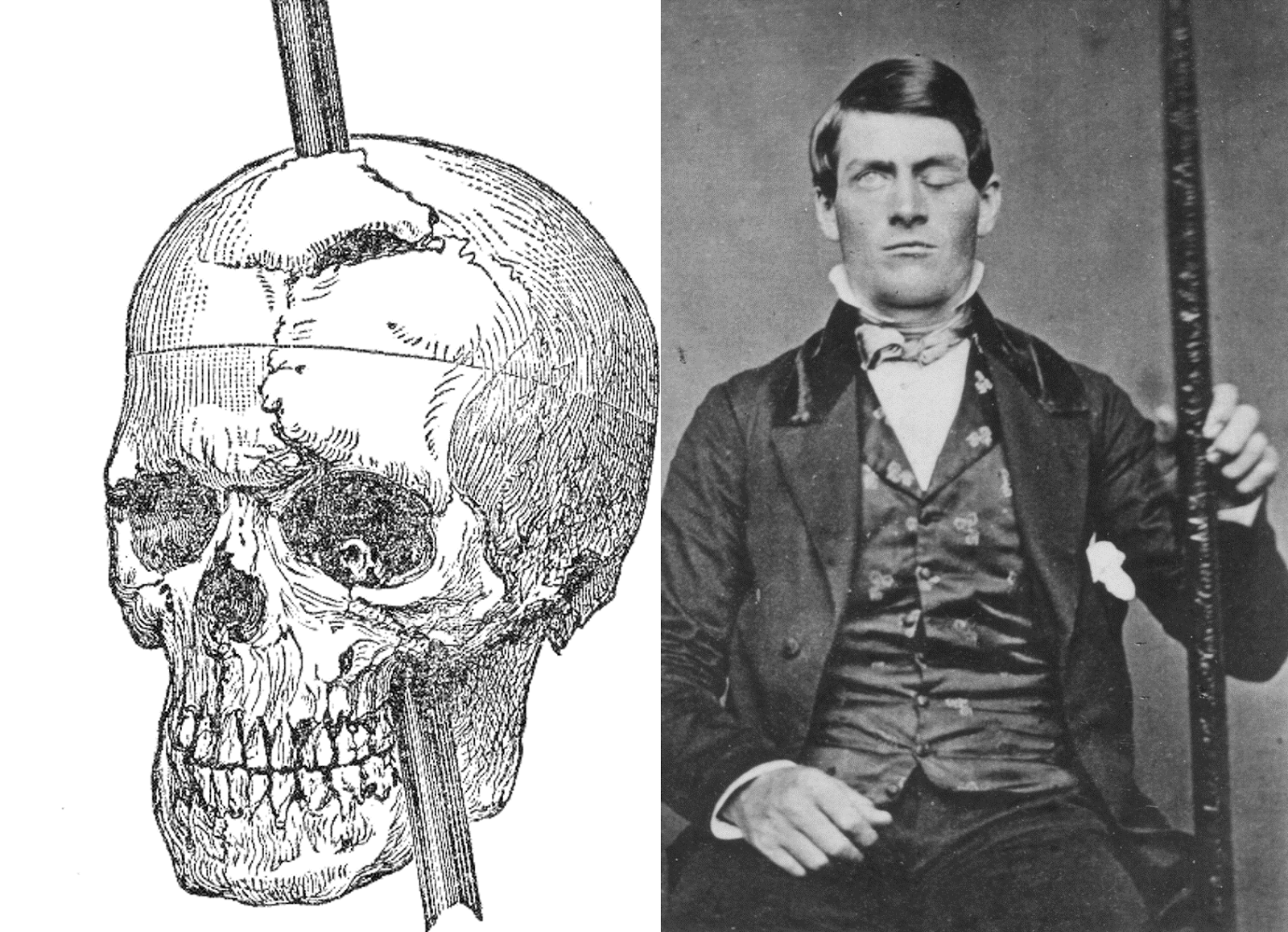 phineas gage case study simply psychology